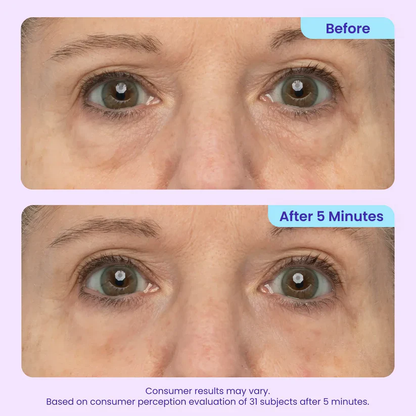 Erase Eye Bags in Minutes — Look Refreshed Instantly